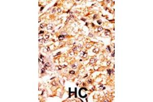 Formalin-fixed and paraffin-embedded human cancer tissue reacted with the primary antibody, which was peroxidase-conjugated to the secondary antibody, followed by AEC staining. (p107 抗体  (pSer975))
