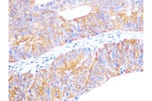 Immunohistochemistry of paraffin-embedded human colon carcinoma using Cyclophilin 40 Rabbit mAb (ABIN7269213) at dilution of 1:100 (40x lens). (PPID 抗体)