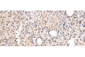 Immunohistochemistry of paraffin-embedded Human thyroid cancer using CBX7 Polyclonal Antibody at dilution of 1/20 (CBX7 抗体)