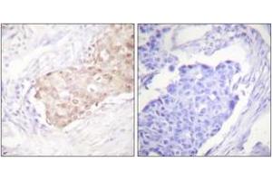 Immunohistochemistry analysis of paraffin-embedded human breast carcinoma tissue, using EDD Antibody.