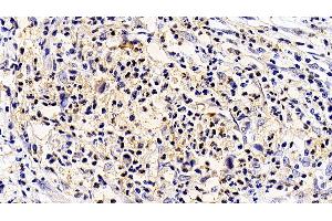 Detection of IL5Ra in Human Stomach cancer Tissue using Polyclonal Antibody to Interleukin 5 Receptor Alpha (IL5Ra) (IL5RA 抗体  (AA 42-182))