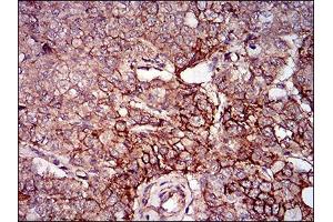 Immunohistochemical analysis of paraffin-embedded prostate cancer tissues using mSplunc2 mouse mAb with DAB staining. (BPIFA2 抗体  (AA 16-169))