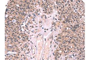 The image on the left is immunohistochemistry of paraffin-embedded Human ovarian cancer tissue using ABIN7190608(EXTL1 Antibody) at dilution 1/20, on the right is treated with synthetic peptide. (EXTL1 抗体)