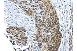 The image on the left is immunohistochemistry of paraffin-embedded Human esophagus cancer tissue using (TKTL1 Antibody) at dilution 1/40, on the right is treated with fusion protein. (TKTL1 抗体)