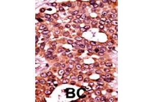 Formalin-fixed and paraffin-embedded human cancer tissue reacted with CDC6 (phospho S54) polyclonal antibody  which was peroxidase-conjugated to the secondary antibody followed by AEC staining. (CDC6 抗体  (pSer54))