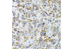 Immunohistochemistry of paraffin-embedded human liver cancer using RPN1 antibody. (RPN1 抗体  (AA 20-280))