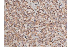 ABIN6269036 at 1/200 staining human breast cancer tissue sections by IHC-P. (JUP 抗体  (C-Term))