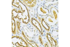 Immunohistochemistry of paraffin-embedded human kidney cancer using GLRX Antibody (ABIN1876503) at dilution of 1:200 (40x lens). (Glutaredoxin 1 抗体)