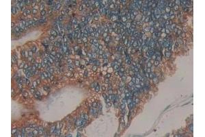 Detection of PRLR in Human Colorectal cancer Tissue using Polyclonal Antibody to Prolactin Receptor (PRLR)