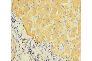 Immunohistochemistry of paraffin-embedded human liver cancer using ABIN7158796 at dilution of 1:100 (LAPTM5 抗体  (AA 205-262))