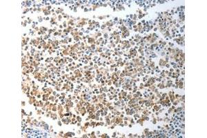 Immunohistochemical analysis of paraffin-embedded Human liver cancer tissue using at dilution 1/40. (CHD5 抗体  (C-Term))