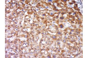 Formalin-fixed and paraffin embedded human liver carcinoma labeled with Anti-FAIM3 Polyclonal Antibody, Unconjugated  at 1:500 followed by conjugation to the secondary antibody and DAB staining.