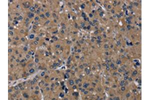 The image on the left is immunohistochemistry of paraffin-embedded Human liver cancer tissue using ABIN7192919(TRPM1 Antibody) at dilution 1/20, on the right is treated with synthetic peptide. (TRPM1 抗体)
