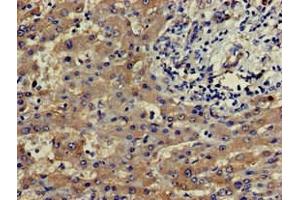 Immunohistochemistry of paraffin-embedded human liver cancer using ABIN7164181 at dilution of 1:100 (SLU7 抗体  (AA 138-310))