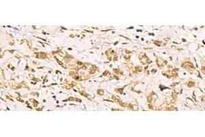 Immunohistochemistry of paraffin-embedded Human gastric cancer tissue using PDS5A Polyclonal Antibody at dilution of 1:90(x200) (PDS5A 抗体)