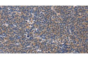 Immunohistochemistry of paraffin-embedded Human Lymphoma tissue using CD5L Polyclonal Antibody at dilution 1:40 (CD5L 抗体)