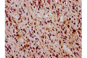 IHC image of ABIN7127707 diluted at 1:100 and staining in paraffin-embedded human glioma cancer performed on a Leica BondTM system. (Recombinant ERK1 抗体  (pThr185, pThr202))