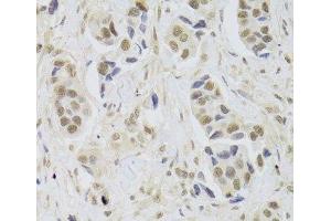 Immunohistochemistry of paraffin-embedded Human breast cancer using UBE3C Polyclonal Antibody at dilution of 1:100 (40x lens). (UBE3C 抗体)
