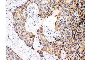 Anti-Caspase-12 antibody, IHC(P) IHC(P): Human Mammary Cancer Tissue (Caspase 12 抗体  (N-Term))