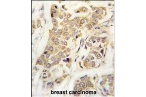 Formalin-fixed and paraffin-embedded human breast carcinoma tissue reacted with CDH8 antibody (N-term) (ABIN388149 and ABIN2846895) , which was peroxidase-conjugated to the secondary antibody, followed by DAB staining. (Cadherin 8 抗体  (N-Term))