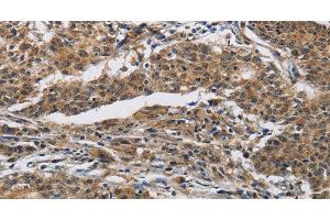 Immunohistochemistry of paraffin-embedded Human gastric cancer using IFNGR2 Polyclonal Antibody at dilution of 1:40 (IFNGR2 抗体)