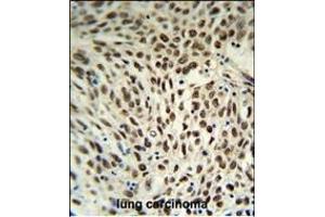 SNRPD3 Antibody (C-term) (ABIN653228 and ABIN2842762) IHC analysis in formalin fixed and paraffin embedded human lung carcinoma followed by peroxidase conjugation of the secondary antibody and DAB staining.