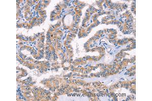 Immunohistochemistry of Human lung cancer using AP1B1 Polyclonal Antibody at dilution of 1:70 (AP1B1 抗体)