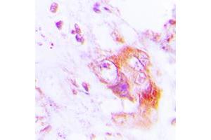 Immunohistochemical analysis of PKR (pT451) staining in human lung cancer formalin fixed paraffin embedded tissue section.
