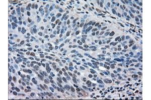 Immunohistochemical staining of paraffin-embedded Adenocarcinoma of breast tissue using anti-MAPK1 mouse monoclonal antibody. (ERK2 抗体)