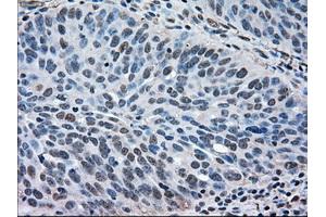 Immunohistochemical staining of paraffin-embedded Adenocarcinoma of breast tissue using anti-MAPK1 mouse monoclonal antibody.