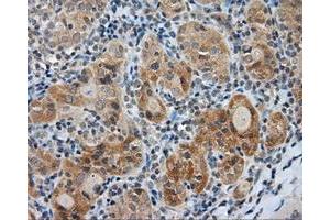 Immunohistochemical staining of paraffin-embedded Adenocarcinoma of colon tissue using anti-LIPG mouse monoclonal antibody. (LIPG 抗体)