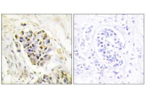 Immunohistochemistry analysis of paraffin-embedded human breast carcinoma tissue using MED1 antibody. (MED1 抗体  (Internal Region))