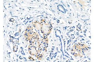 ABIN6257207 and ABIN6275954 at 1/100 staining Human pancreatic cancer by IHC-P. (G Protein-Coupled Receptor 119 抗体  (Internal Region))
