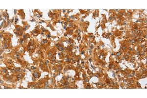 Immunohistochemistry of paraffin-embedded Human thyroid cancer using cPLA2 Polyclonal Antibody at dilution of 1:50 (PLA2G4A 抗体)