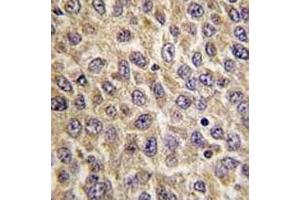 IHC analysis of FFPE human hepatocarcinoma tissue stained with ILK antibody