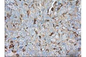 Immunohistochemical staining of paraffin-embedded Adenocarcinoma of colon tissue using anti-ALDH3A1 mouse monoclonal antibody.