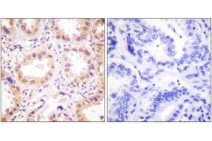 Immunohistochemistry analysis of paraffin-embedded human lung carcinoma tissue, using NEDD8 Antibody. (NEDD8 抗体  (AA 10-59))