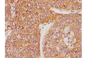 IHC image of ABIN7164243 diluted at 1:100 and staining in paraffin-embedded human liver cancer performed on a Leica BondTM system. (PSG9 抗体  (AA 241-426))