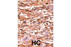 Formalin-fixed and paraffin-embedded human cancer tissue reacted with the primary antibody, which was peroxidase-conjugated to the secondary antibody, followed by AEC staining. (VEGFR2/CD309 抗体  (pTyr996))