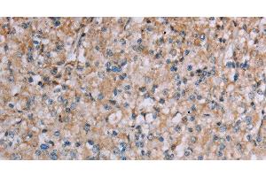 Immunohistochemistry of paraffin-embedded Human prostate cancer tissue using PLXNA4 Polyclonal Antibody at dilution 1:50 (Plexin A4 抗体)