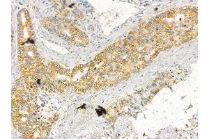 BAT3 Mouse Monoclonal Antibody at 1/100 staining human lung cancer by IHC-P. (BAT3 抗体)
