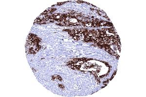 Muscle invasive urothelial carcinoma of the urinary bladder showing a strong Upk1b immunostaining of tumor cells (Uroplakin 1B 抗体  (AA 109-229))