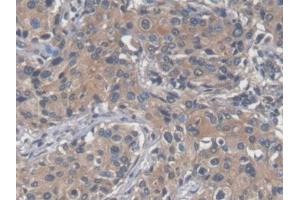 DAB staining on IHC-P; Samples: Human Prostate cancer Tissue (SAA 抗体  (AA 19-122))