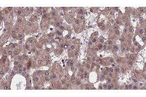 ABIN6277524 at 1/100 staining Human liver cancer tissue by IHC-P. (SLC4A4 抗体  (C-Term))