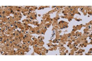 Immunohistochemistry of paraffin-embedded Human prostate cancer tissue using IFRD1 Polyclonal Antibody at dilution 1:40 (IFRD1 抗体)