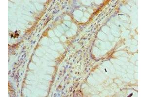 Immunohistochemistry of paraffin-embedded human colon cancer using ABIN7142923 at dilution of 1:100 (MUTYH 抗体  (AA 1-265))