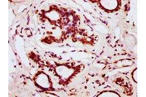 IHC image of ABIN7145662 diluted at 1:200 and staining in paraffin-embedded human breast cancer performed on a Leica BondTM system. (BOLA2 抗体  (AA 1-86))