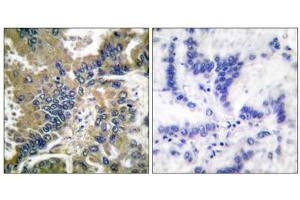 Immunohistochemical analysis of paraffin-embedded human lung carcinoma tissue, using Caspase 1 (Cleaved-Asp210) antibody (ABIN5978453). (Caspase 1 抗体  (Cleaved-Asp210, Internal Region))