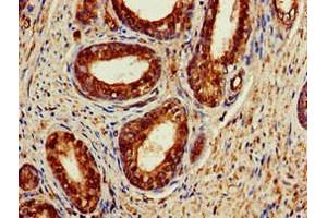 Immunohistochemistry of paraffin-embedded human prostate cancer using ABIN7142946 at dilution of 1:100 (ACAT1 抗体  (AA 76-106))