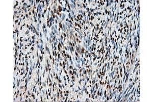 Immunohistochemical staining of paraffin-embedded Adenocarcinoma of ovary tissue using anti-HSPA1A mouse monoclonal antibody. (HSP70 1A 抗体)